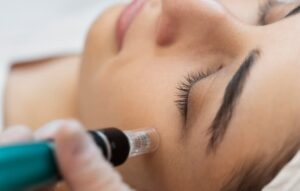 میکرونیدلینگ صورت برای پوست شفاف و بدون لک در کلینیک تخصصی